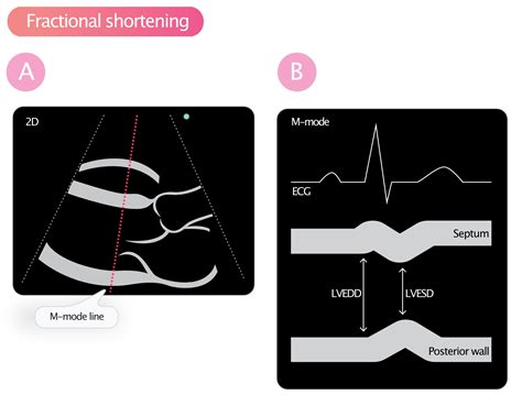 echo lv function|ejection fraction vs fractional shortening.